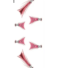Stretched trauma tatovering